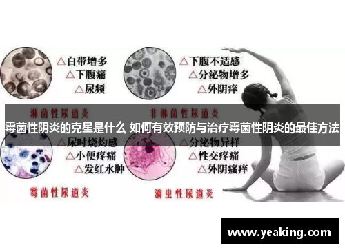 霉菌性阴炎的克星是什么 如何有效预防与治疗霉菌性阴炎的最佳方法